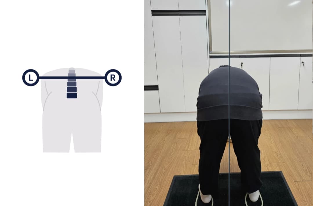 POMS 척추측만 측정 예시